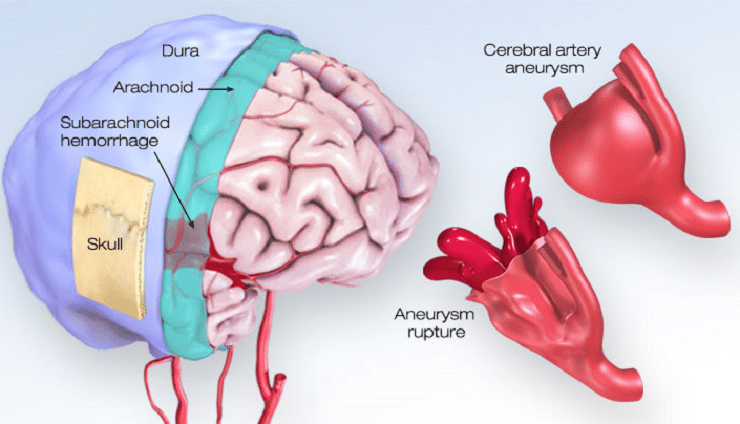 Brain Aneurysm Treatment