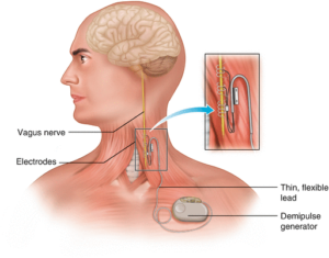 Transcutaneous Vagus Nerve Stimulation