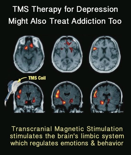Illustrative representation of a brain scan and regions affected by TMS therapy