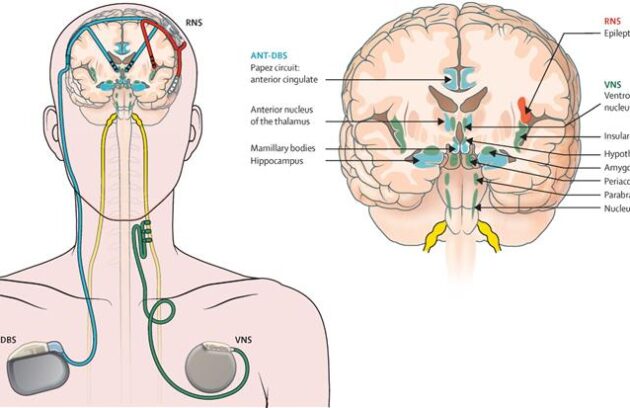 Illustrative representation of neuromodulation therapy in epilepsy