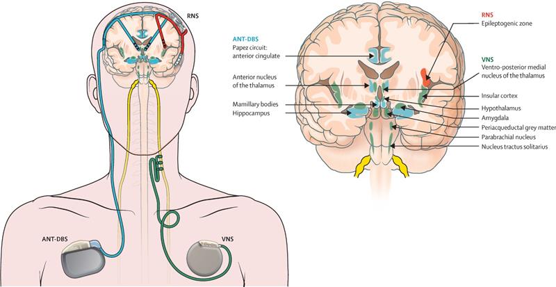 Illustrative representation of neuromodulation therapy in epilepsy