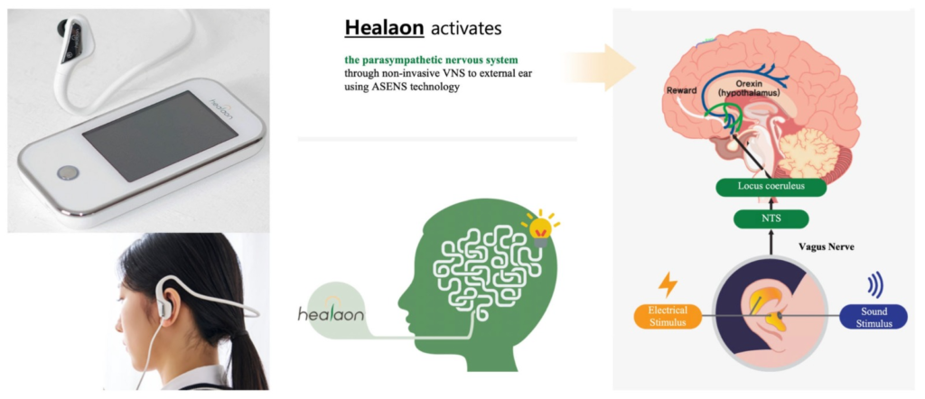 Illustrative representation of Vagus Nerve Stimulation Heal on Device