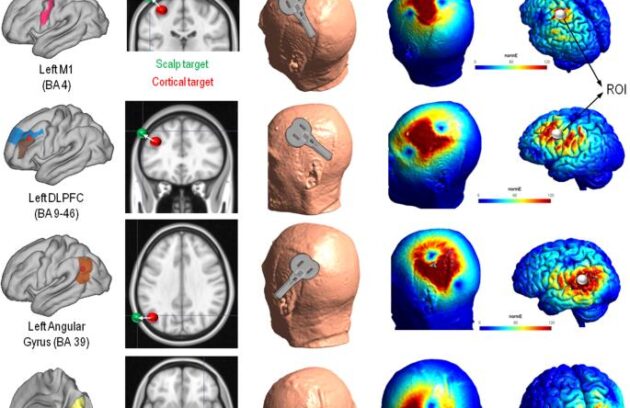 Illustrative representation of TMS optimization solution on the brain of an individual