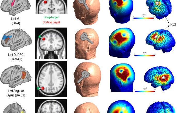 Illustrative representation of TMS optimization solution on the brain of an individual